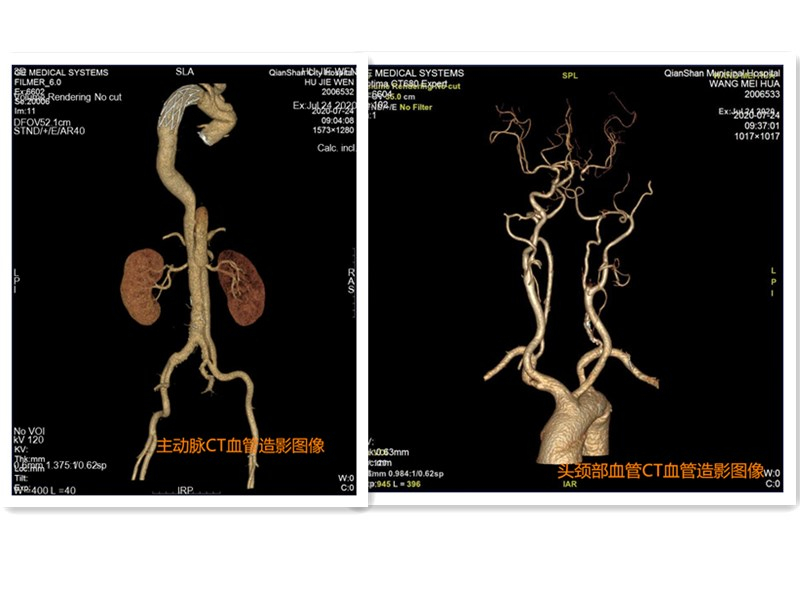 我院成功开展头颈部血管、主动脉及肺动脉CT血管造影检查新项目